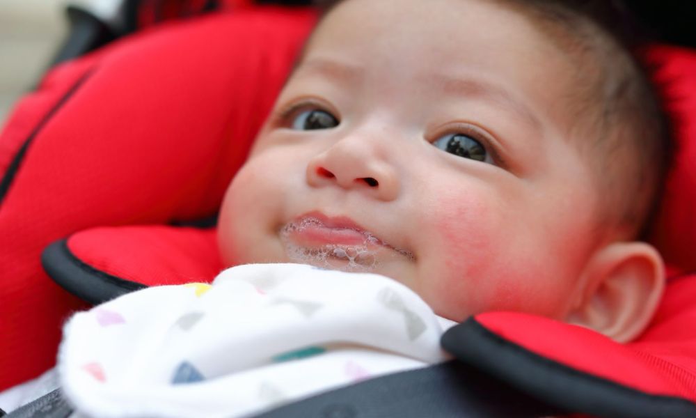 Smiling baby with drool rash